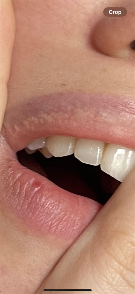 What are these dots on my lips? I have it only on my upper lip and all ...