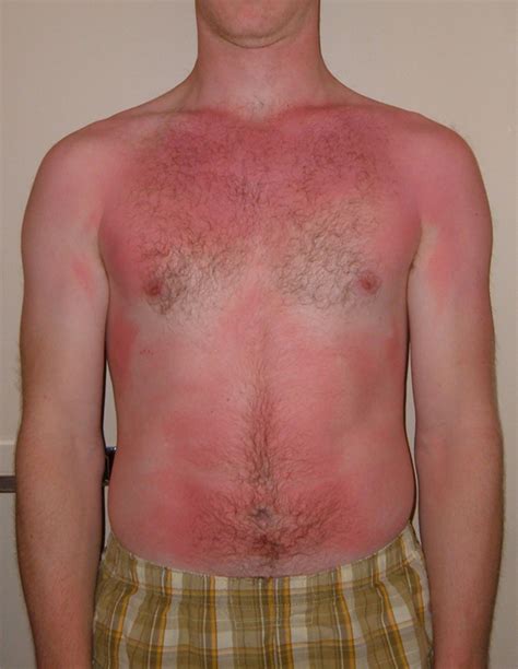 2nd Degree Sunburns