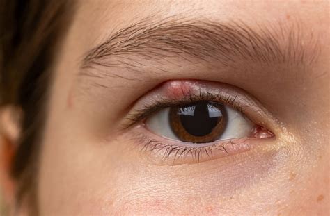 Are Styes Contagious? | Wes McCann: Central Optometry