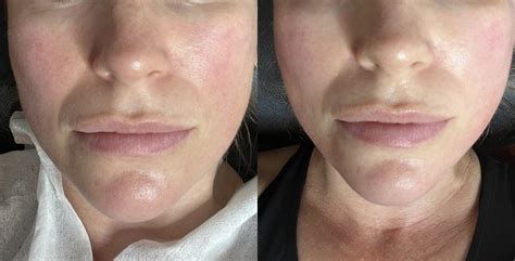 Focus Dual® Radiofrequency Microneedling - NFBC