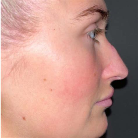 Septorhinoplasty | Deviated Septum | Pall Mall