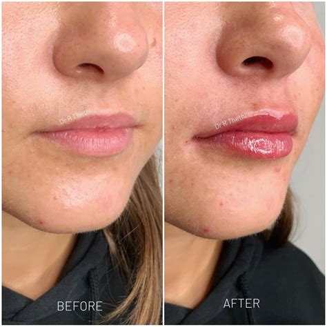 0.5 ml Lip Filler Before and After - Yorkshire Skin Center