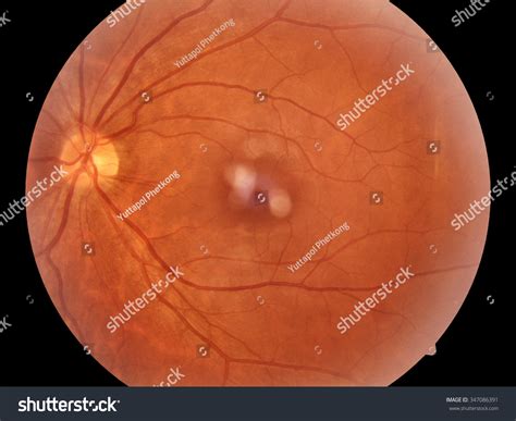 Human Eye Anatomy Retina Optic Disc Stock Photo (Edit Now) 347086391
