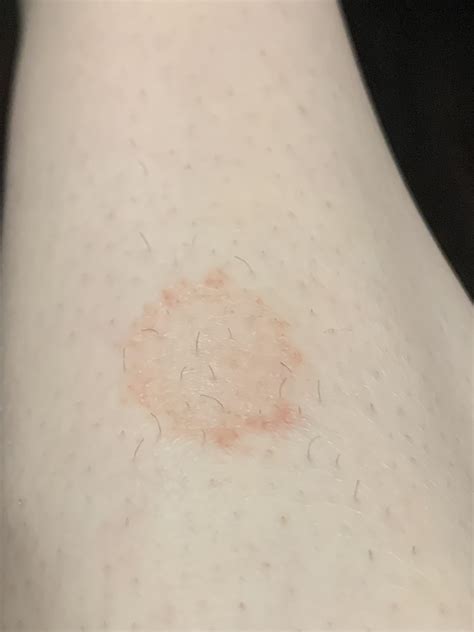 Does this look like ringworm? It is not itchy. It’s on my leg. : r/Skincare_Addiction