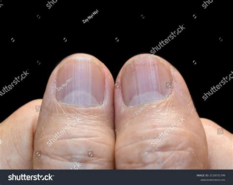 Large Half Moons On Fingernails