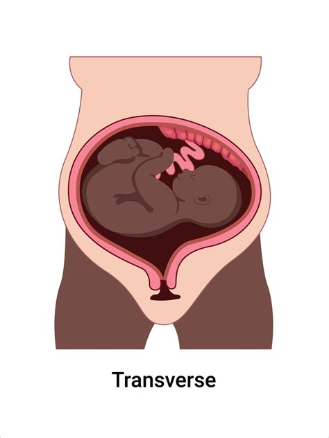 Transverse baby positions in the uterus during pregnancy. Dark-skinned woman. Pathology ...