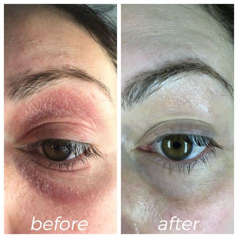 Guide for the natural treatment of eyelid dermatitis – Artofit