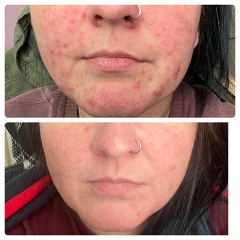 Facial flushing after eating a meal? : r/Rosacea