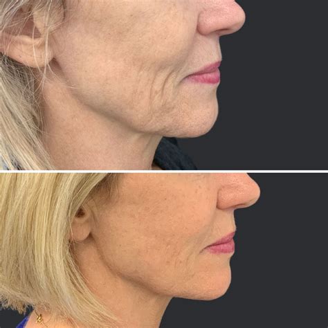 Non-surgical Jowl Lift | Thread Lift, HIFU, Injectables & Fillers for Jowl