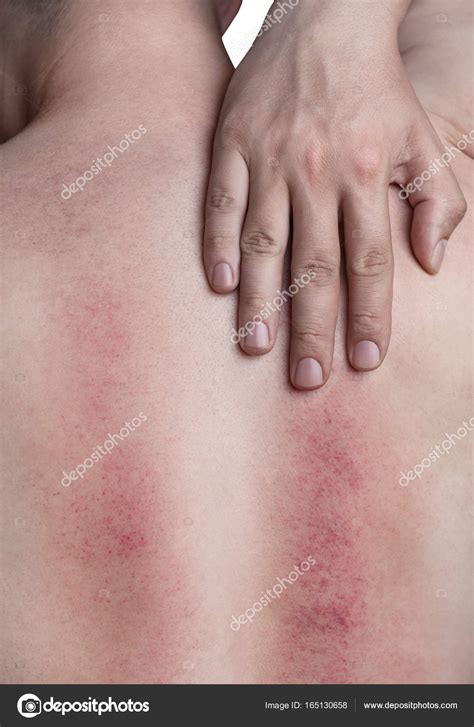 Pityriasis Rosea Linked To Cancer | ppgbbe.intranet.biologia.ufrj.br