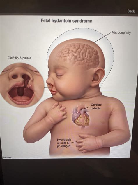 Fetal Hydantoin Syndrome Behavioural And Psychological Issues In Fetal