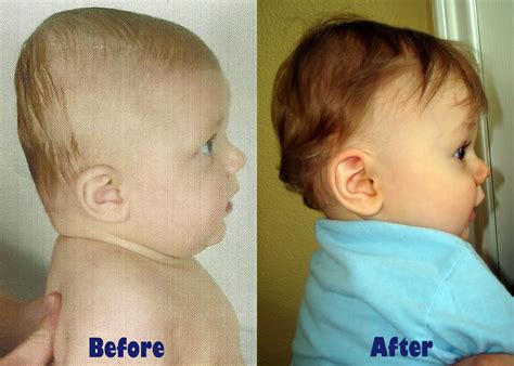Cone Head Baby Before And After at Nicholas Warrior blog