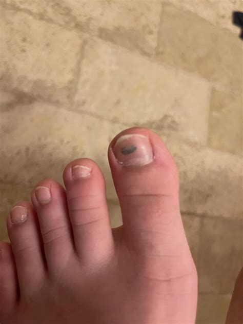 Blood blister won’t go away (read comments for full info) : r/medical_advice