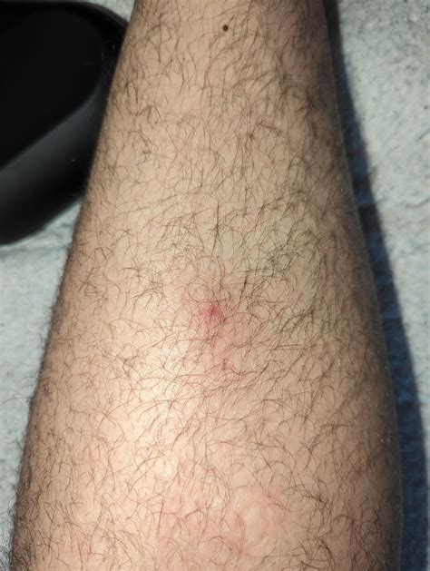 hard swollen bump on shin with redness that's tender to the touch that ...