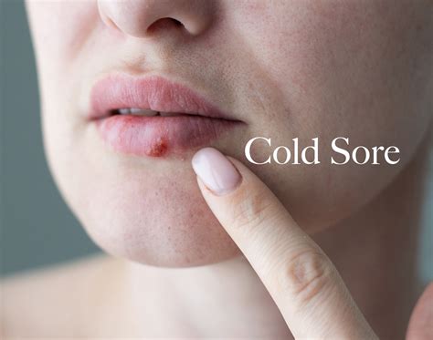 Cold Sores