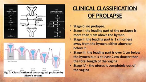 Prolapse Types gynecology practice in medicine | PPTX - stages of vaginal prolapse