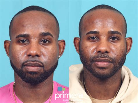 Buccal Fat Removal For Man at Pam Kirkland blog