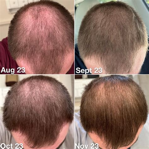 11 months hair-loss treatment progress pics - finasteride, dutasteride, minoxidil : r/Hairloss
