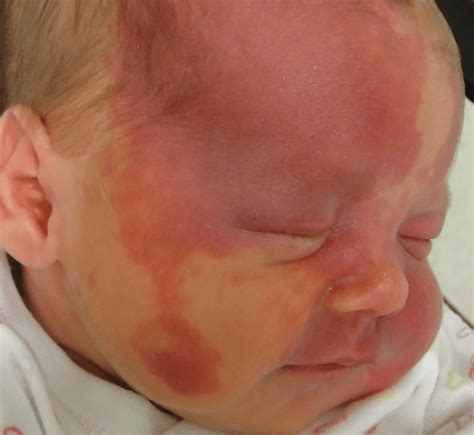 Treat Port-Wine Birthmarks Early to Avoid Progression - Laser NY