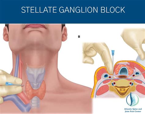 Stellate Ganglion Block | Manalapan, New Jersey | Atlantic Spine and ...