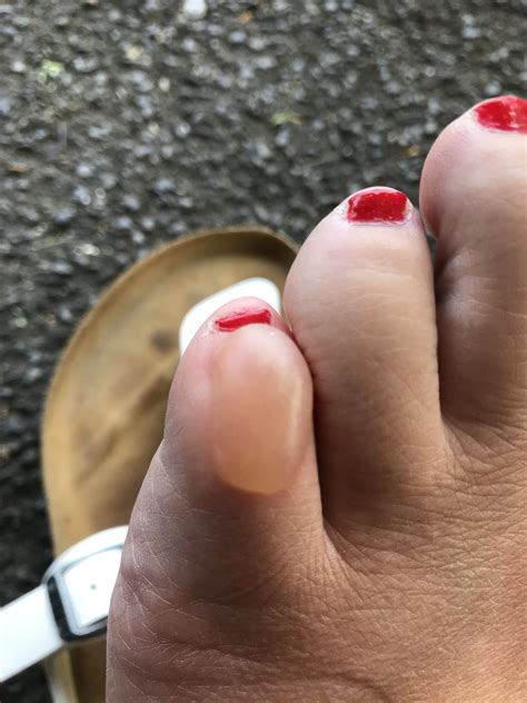 Red Blisters On Toes