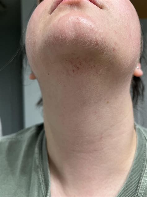non-itchy rash under chin? : r/DermatologyQuestions
