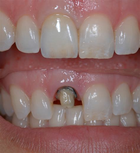 Nfl Ticket Exchange Ravens: Root Canal Crown