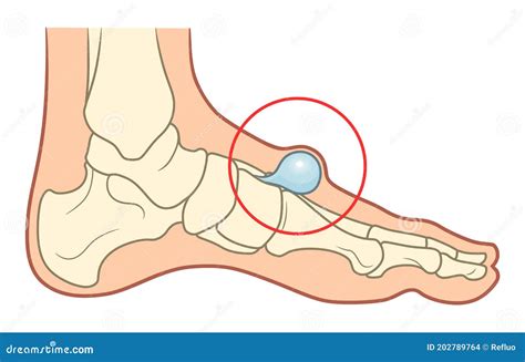Ganglion Cyst On Foot Vector Illustration | CartoonDealer.com #201460404