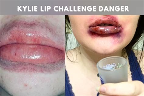 The Dangers of the Kylie Jenner Lip Challenge