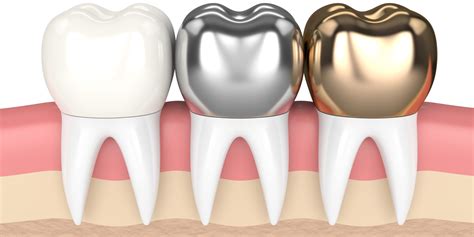 Dentist in Birmingham MI | Birmingham Dentist | Different types of dental crowns
