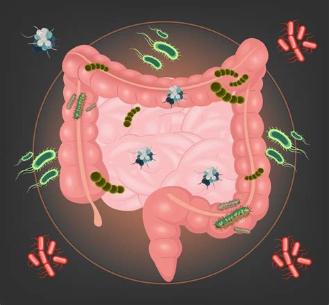 Small Intestine Bacterial Overgrowth: Common but Overlooked Cause of IBS