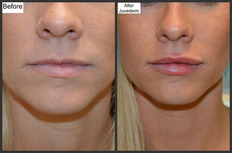 Lip Fillers Before and After Thin Lips