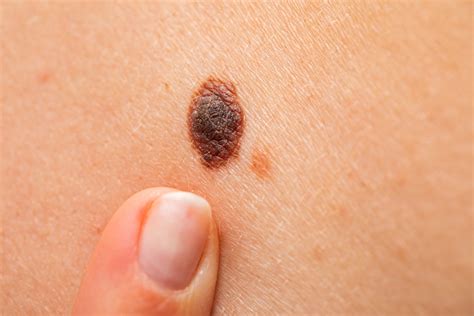 What Is Melanoma? - Epi Dermatology & Laser Specialist Clinic