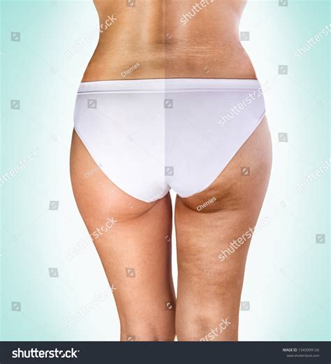 Cellulite Treatment Female Buttocks Before After Stock Photo 1343099126 | Shutterstock