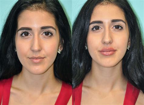What Are The Different Types Of Lip Injections at James Kaiser blog