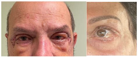 Persistent Conjunctival Chemosis after Lower Lid Blepharoplasty: A Comparison of Different ...