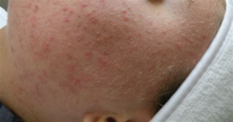 Malassezia On Forehead : Folliculitis, Pityrosporum (Malassezia Folliculitis) – DJHZOA