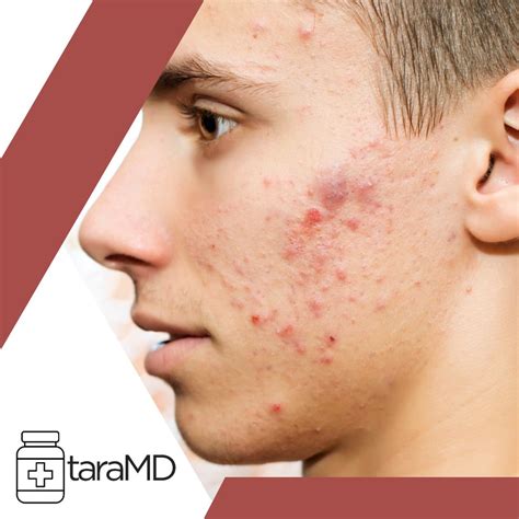 The Hidden Triggers Behind Acne and How to Stop Them - Dr. Tara Akunna
