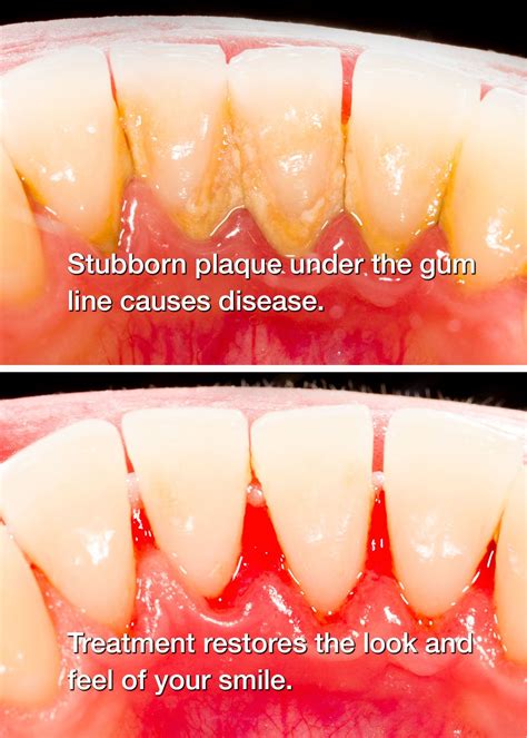 Scaling And Root Planing Mouth Rinse at Glenn Barbee blog