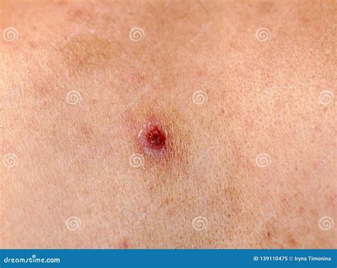 Can A Pimple Bleed A Lot at Patricia Witcher blog