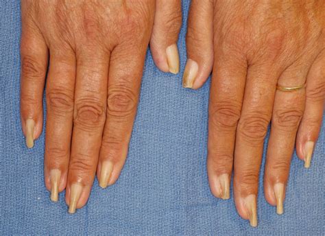 Kidney Disease Fingernails Nail Diseases Skin Health Institute