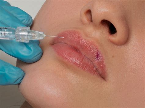 Lip Filler Bruising: Causes, Stages, and Fast Treatments | Hubmed