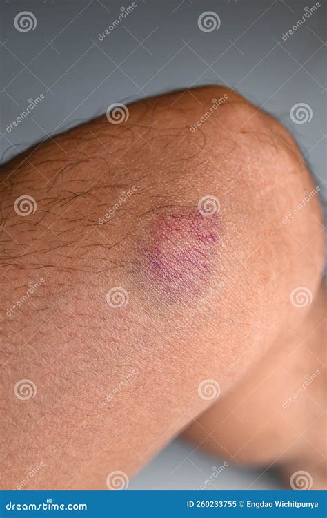 Bruised on Knee - Wound Bruised on Leg Caused by Sports and Bump or Fall, Leg Injury Stock Image ...