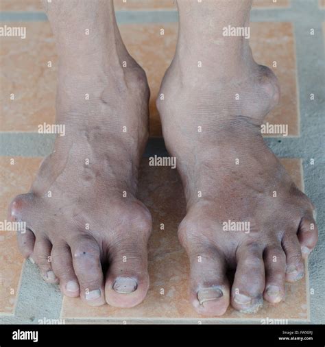 Feet Have Gout at Judy Acosta blog