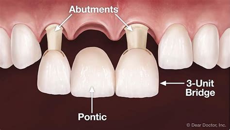 What is a Fixed Dental Bridge? - The Kensington Dentist