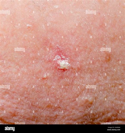 Actinic keratosis or basal cell carcinoma on the scalp of an adult Stock Photo - Alamy