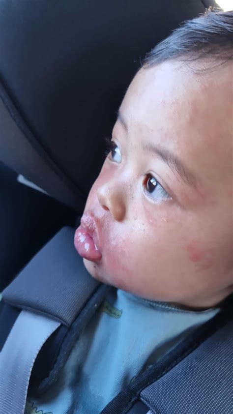 Symptoms of Allergic Reactions in Babies - Solid Starts