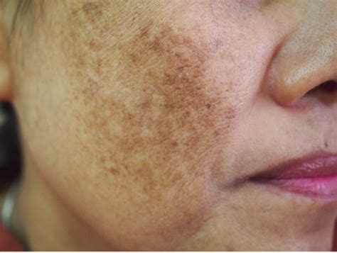 Melasma | Craig Singer MD Dermatology