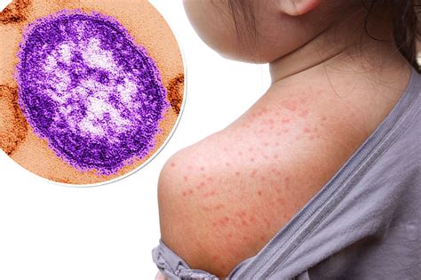 Rubella Rash Vs Measles Rash
