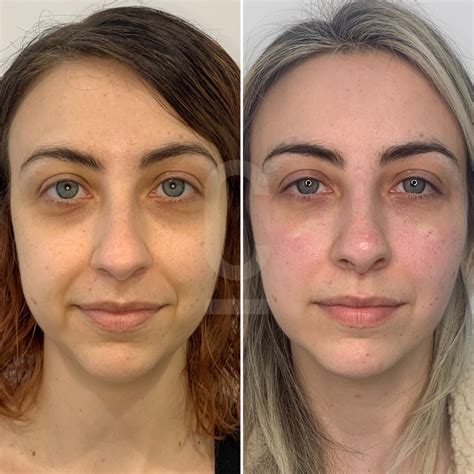 Under Eye Filler - Cosmetic Connection